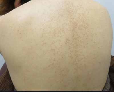 グルテン 毛孔性苔癬 二の腕のブツブツやザラザラ、これって何が原因なの？